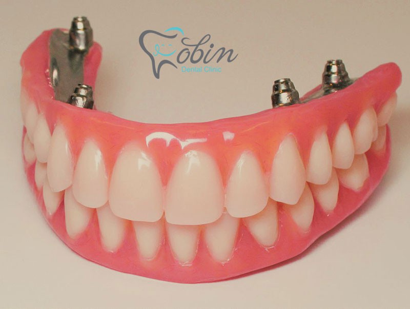 تفاوت های اوردنچر بر پایه ایمپلنت یا دندان های مصنوعی سنتی